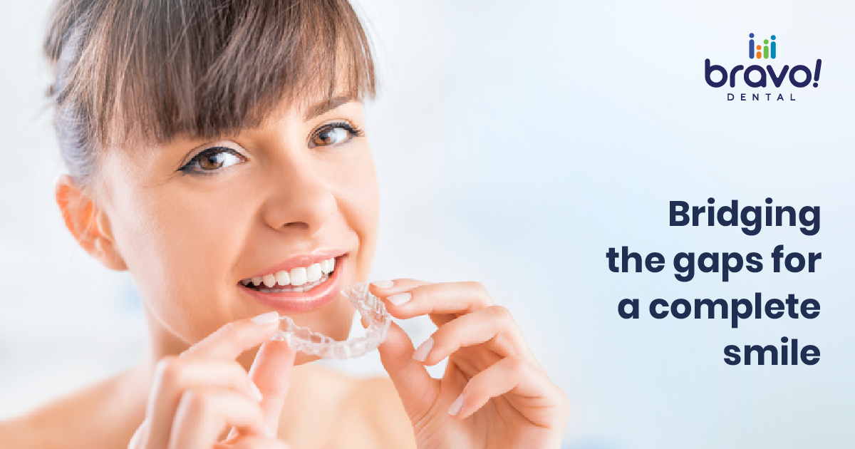 Bridging the gaps for a complete smile