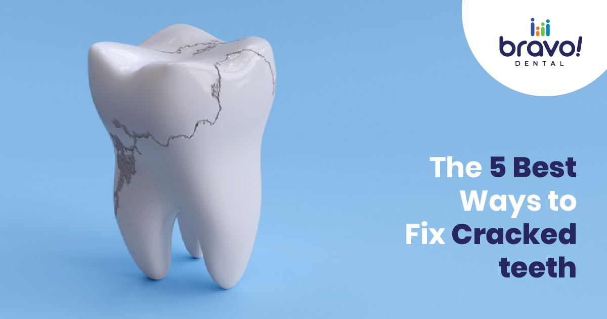 The 5 Best Ways to Fix Cracked Teeth