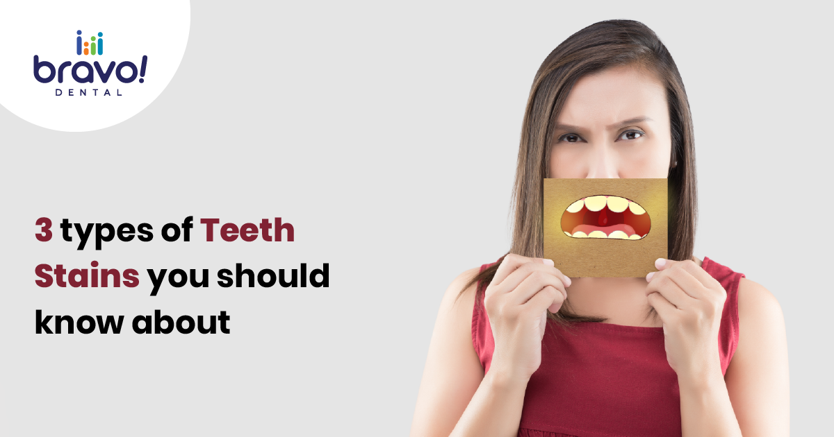 3 types of Teeth Stains you should know about
