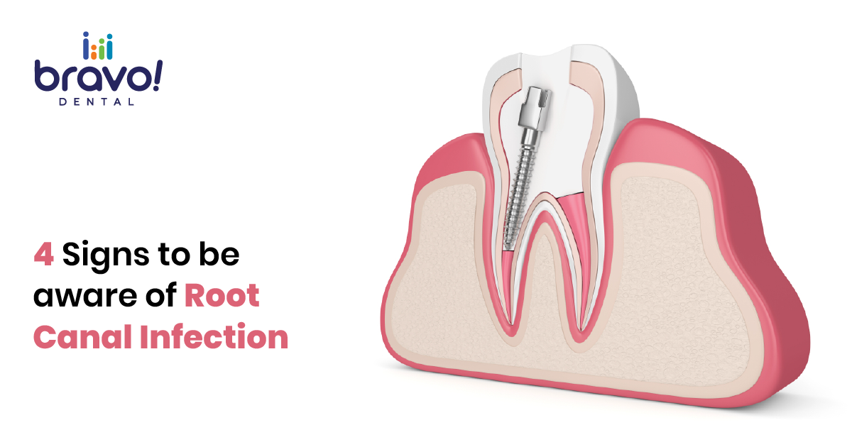 4 Signs to be aware of Root Canal Infection
