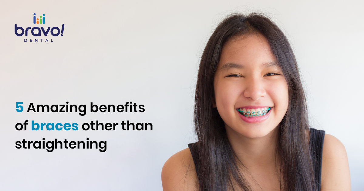 5 Amazing benefits of braces other than straightening your teeth