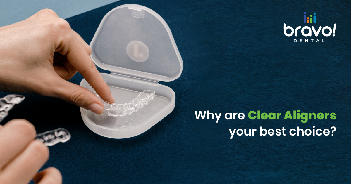 Why are Clear Aligners your best choice?
