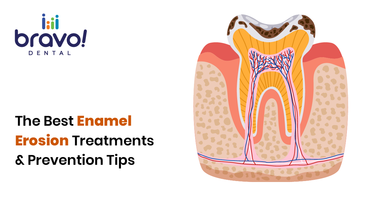 The Best Enamel Erosion Treatments & Prevention Tips