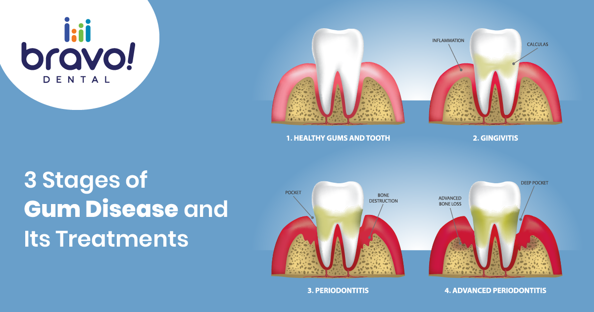 3 Stages of Gum Disease and Its Treatments
