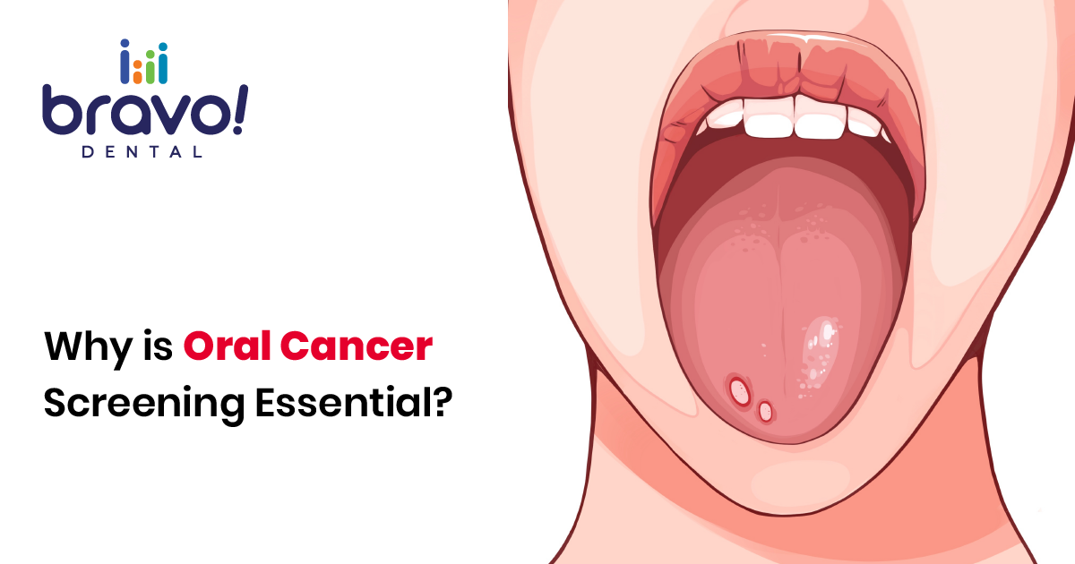 Why is Oral Cancer Screening Essential?