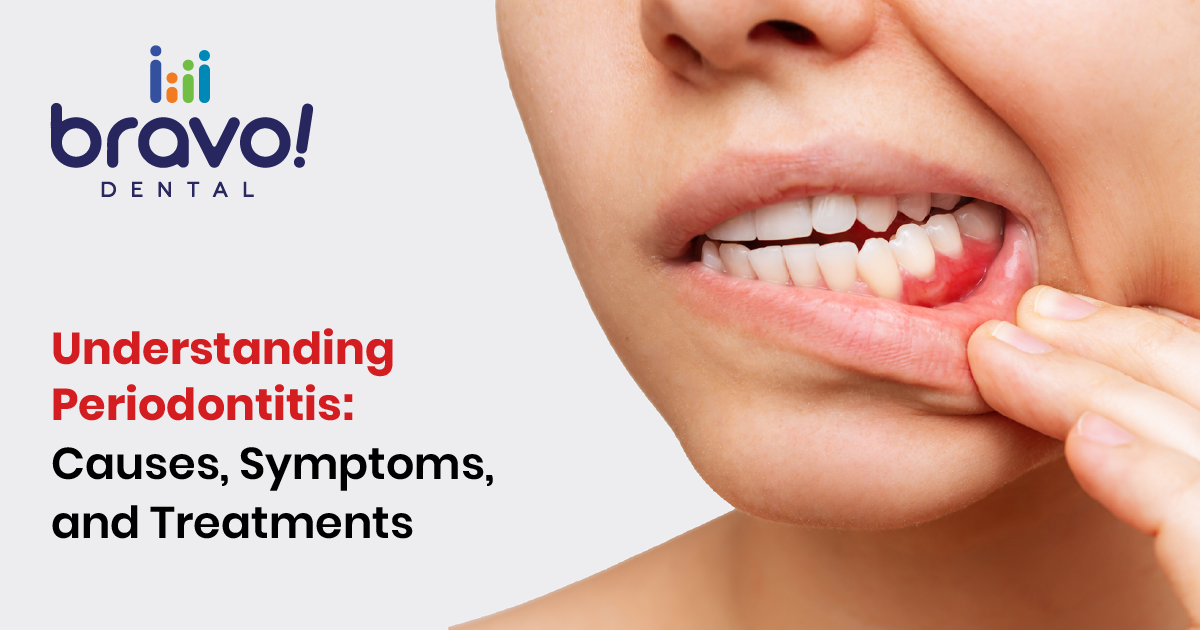 Understanding Periodontitis: Causes, Symptoms, and Treatments