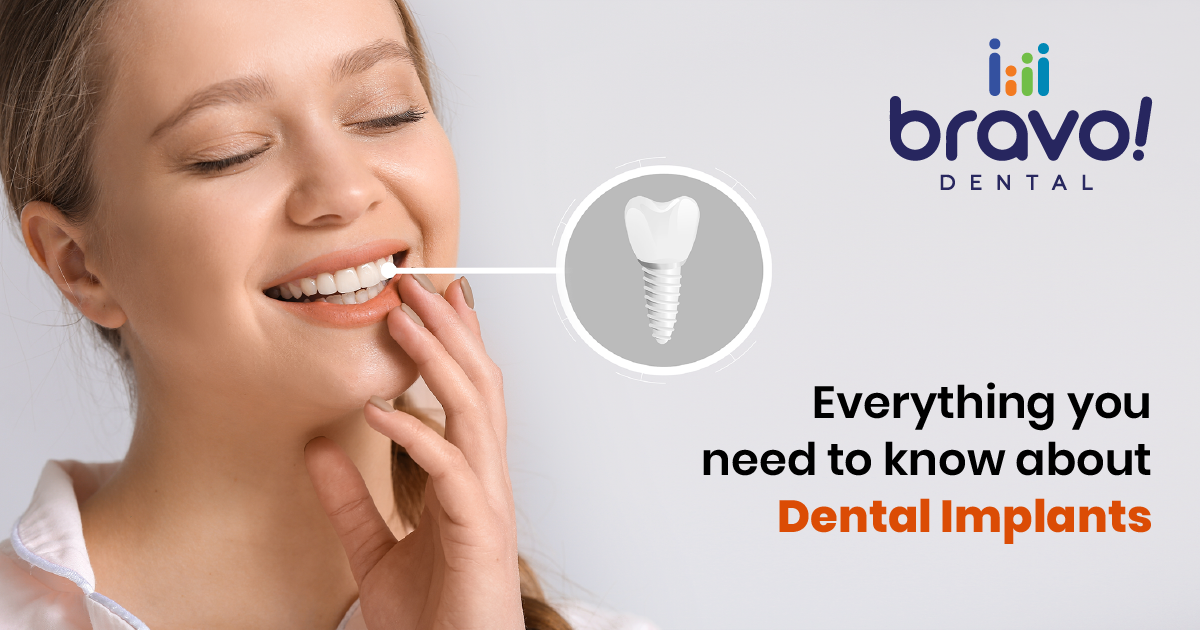 Everything you need to know about Dental Implants