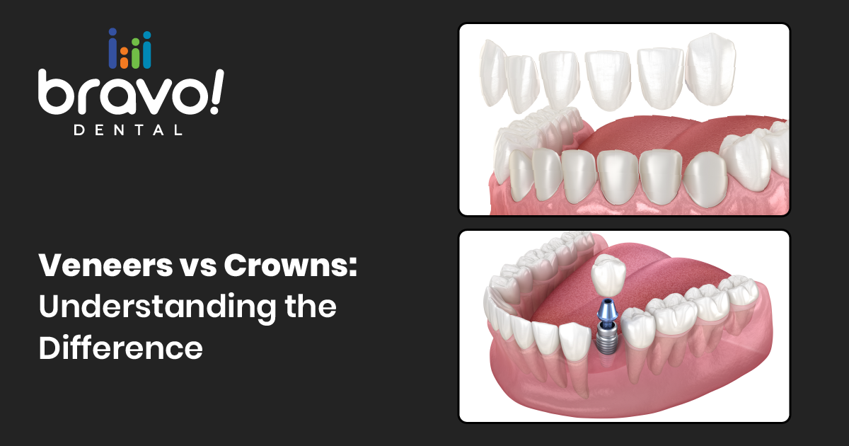Veneers vs Crowns: Understanding the Difference