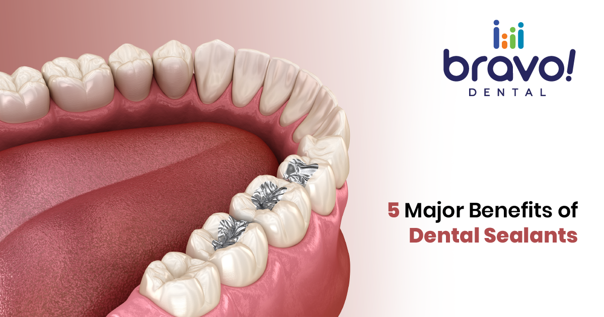 5 Major Benefits of Dental Sealants