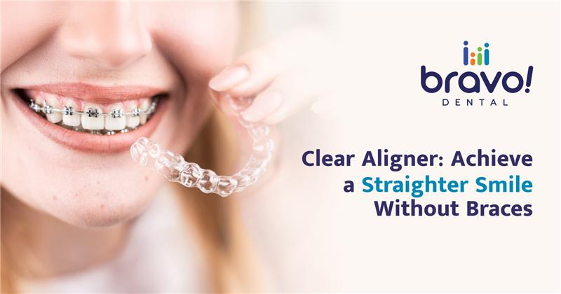 Clear Aligner: Achieve a Straighter Smile Without Braces
